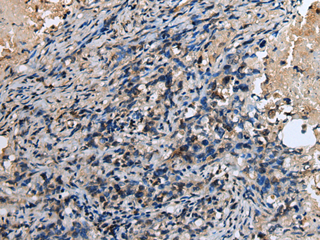 Immunohistochemistry of paraffin-embedded Human lung cancer tissue  using ABHD14B Polyclonal Antibody at dilution of 1:30(×200)