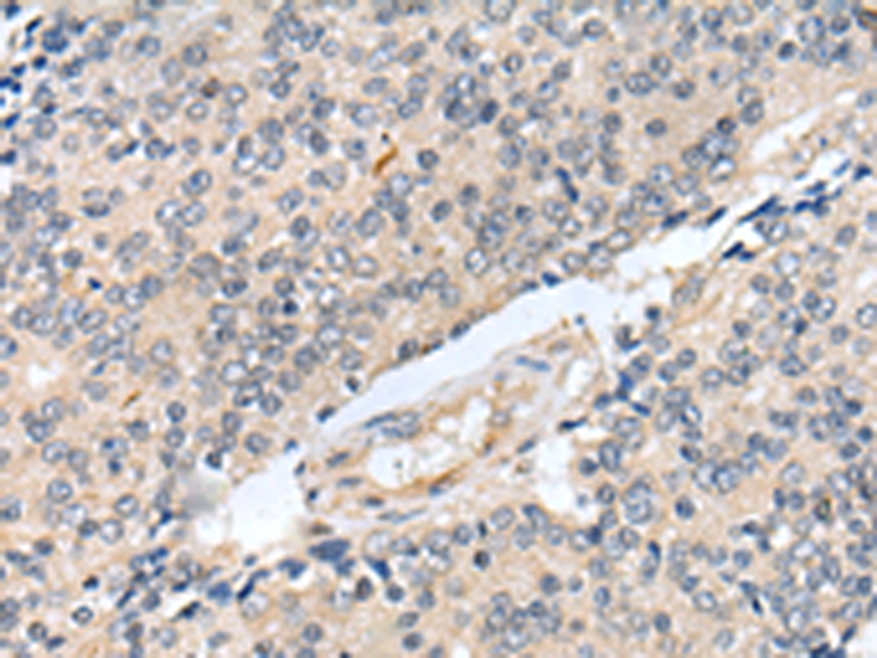 Immunohistochemistry of paraffin-embedded Human prost at e cancer tissue  using MOB1B Polyclonal Antibody at dilution of 1:25(×200)