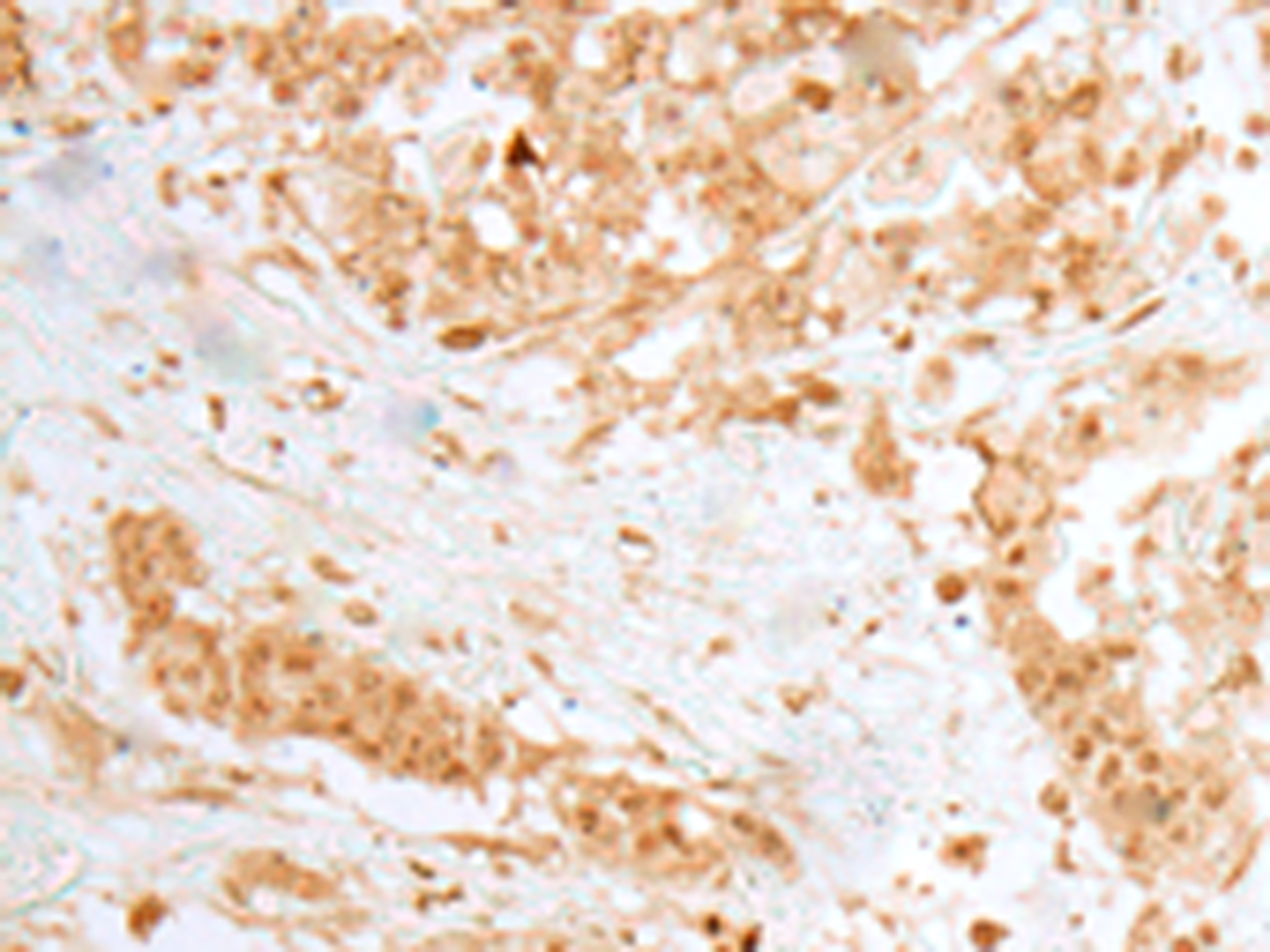 Immunohistochemistry of paraffin-embedded Human colorectal cancer tissue  using MOB1B Polyclonal Antibody at dilution of 1:25(×200)