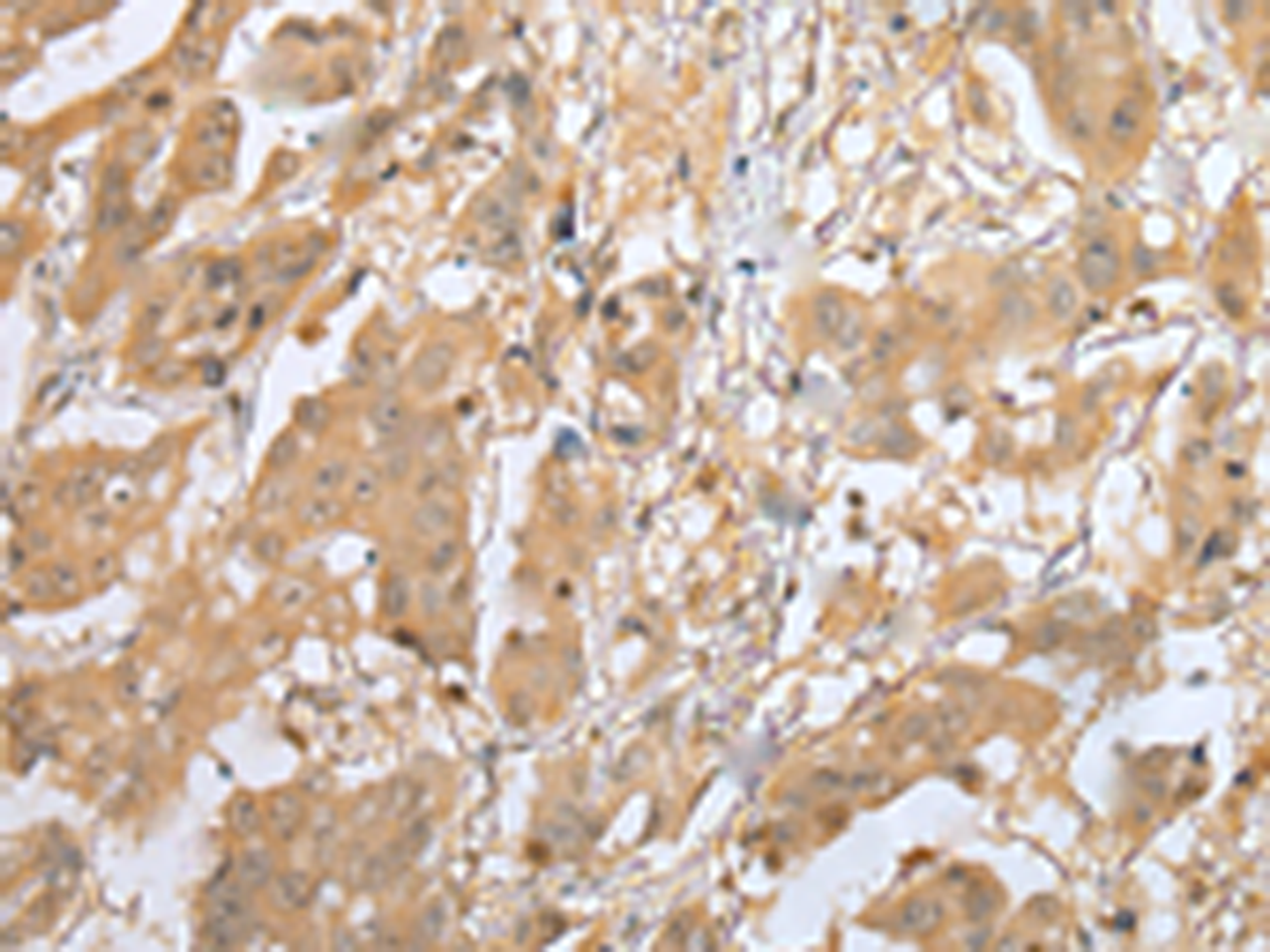 Immunohistochemistry of paraffin-embedded Human breast cancer tissue  using MOB4 Polyclonal Antibody at dilution of 1:25(×200)