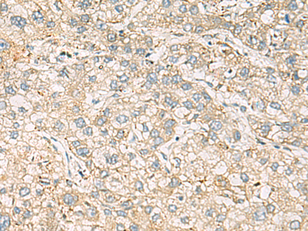 Immunohistochemistry of paraffin-embedded Human liver cancer tissue  using LRRC28 Polyclonal Antibody at dilution of 1:60(×200)