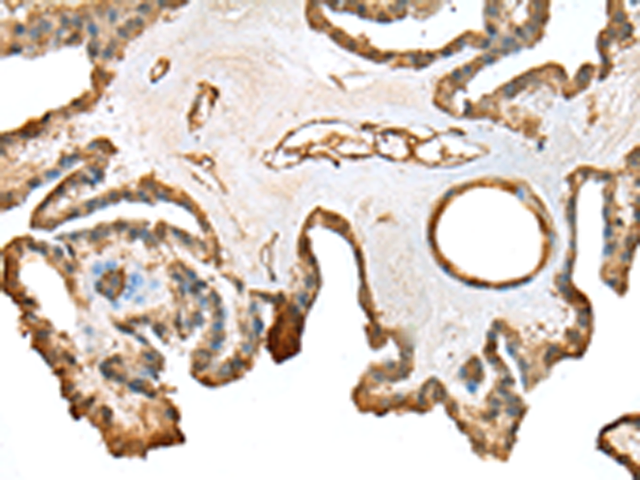 Immunohistochemistry of paraffin-embedded Human thyroid cancer tissue  using SFN Polyclonal Antibody at dilution of 1:25(×200)