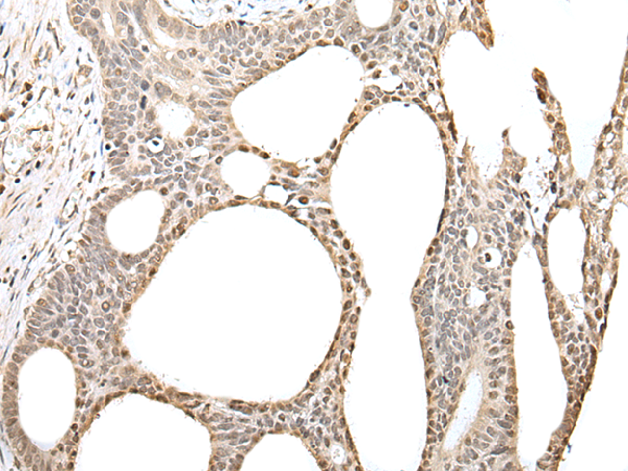 Immunohistochemistry of paraffin-embedded Human gastric cancer tissue  using ZBTB5 Polyclonal Antibody at dilution of 1:40(×200)