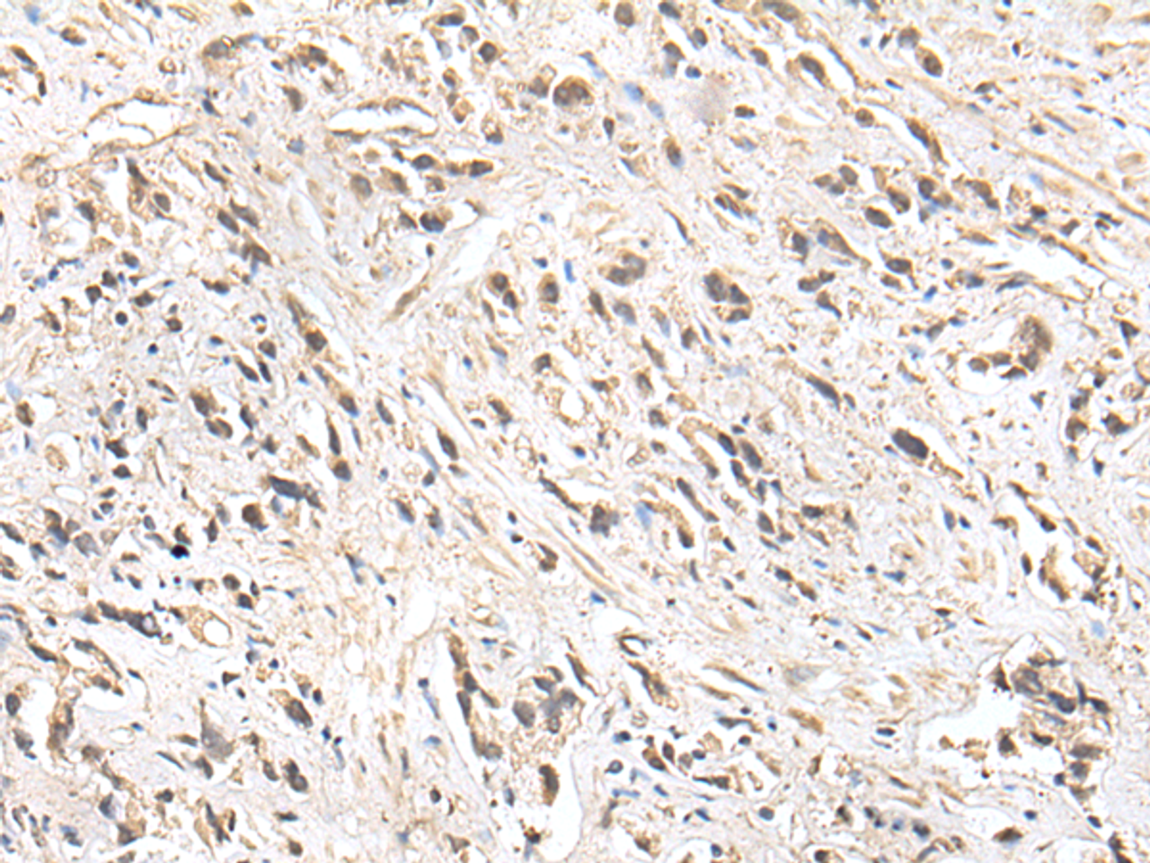 Immunohistochemistry of paraffin-embedded Human prost ate cancer tissue  using ZNF281 Polyclonal Antibody at dilution of 1:30(×200)