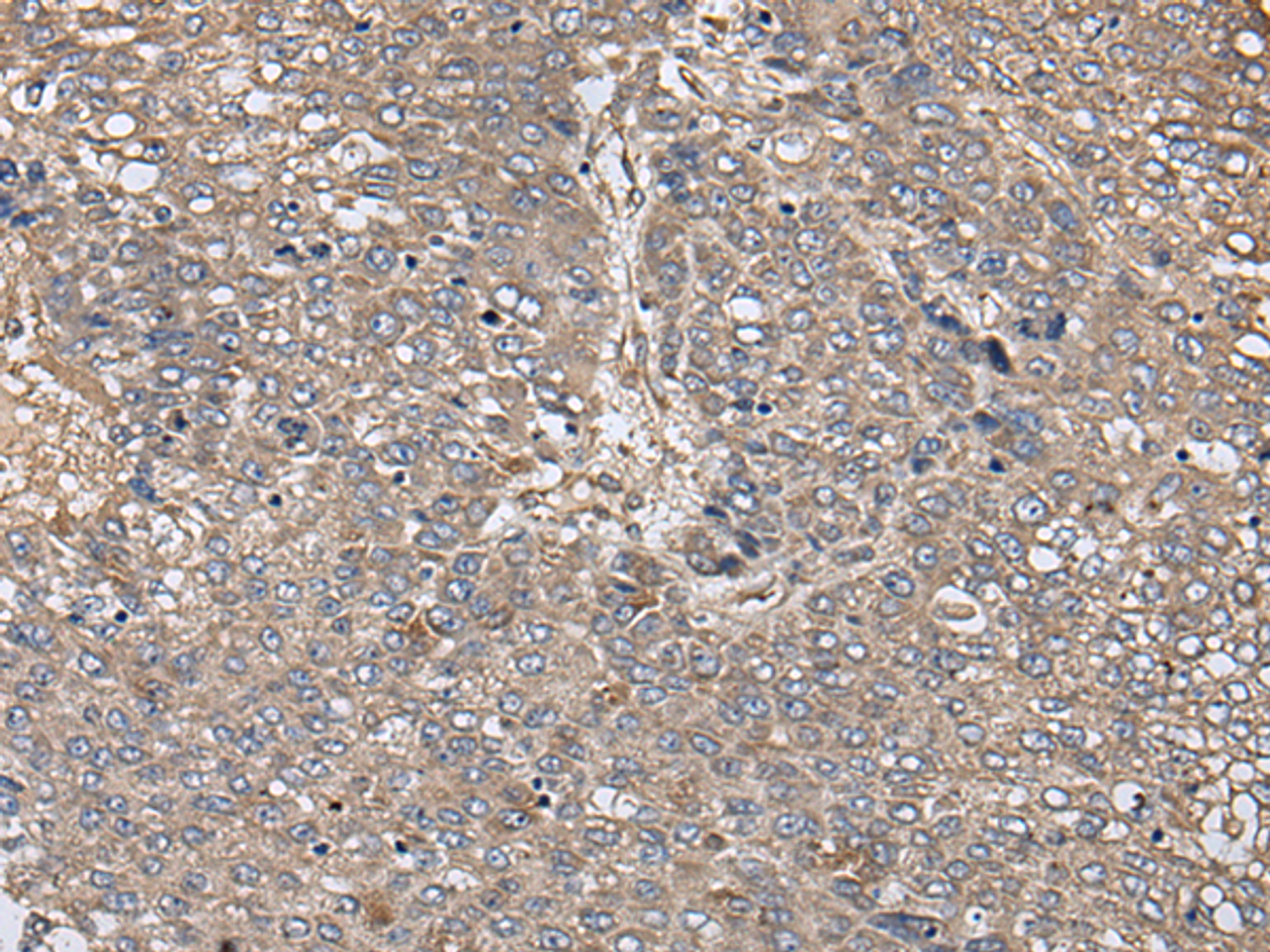 Immunohistochemistry of paraffin-embedded Human liver cancer tissue  using ZFP36 Polyclonal Antibody at dilution of 1:40(×200)