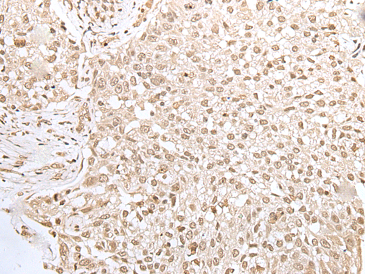 Immunohistochemistry of paraffin-embedded Human lung cancer tissue  using ZKSCAN3 Polyclonal Antibody at dilution of 1:50(×200)