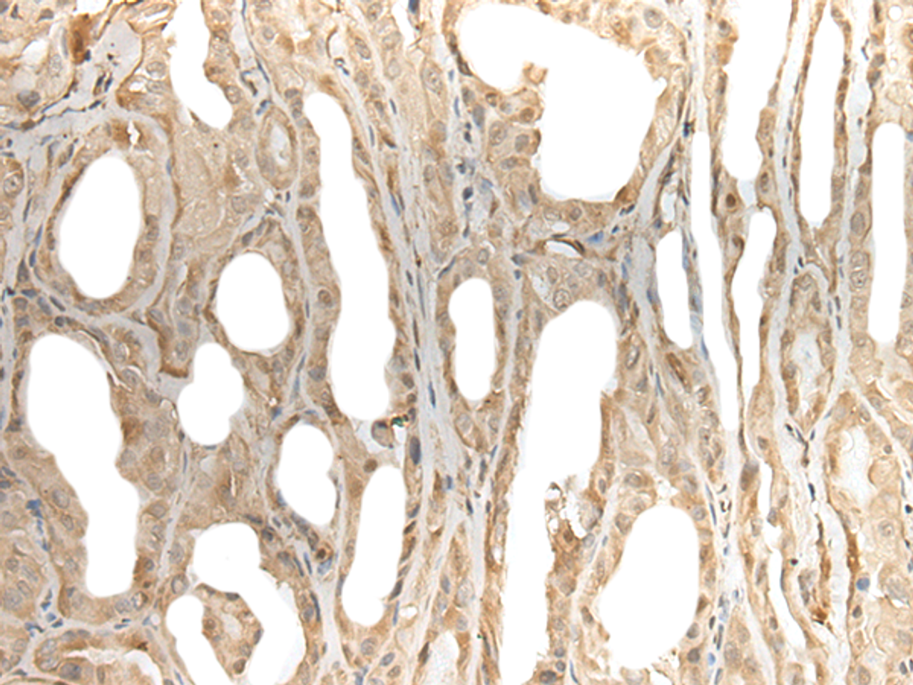 Immunohistochemistry of paraffin-embedded Human thyroid cancer tissue  using ZBTB18 Polyclonal Antibody at dilution of 1:50(×200)