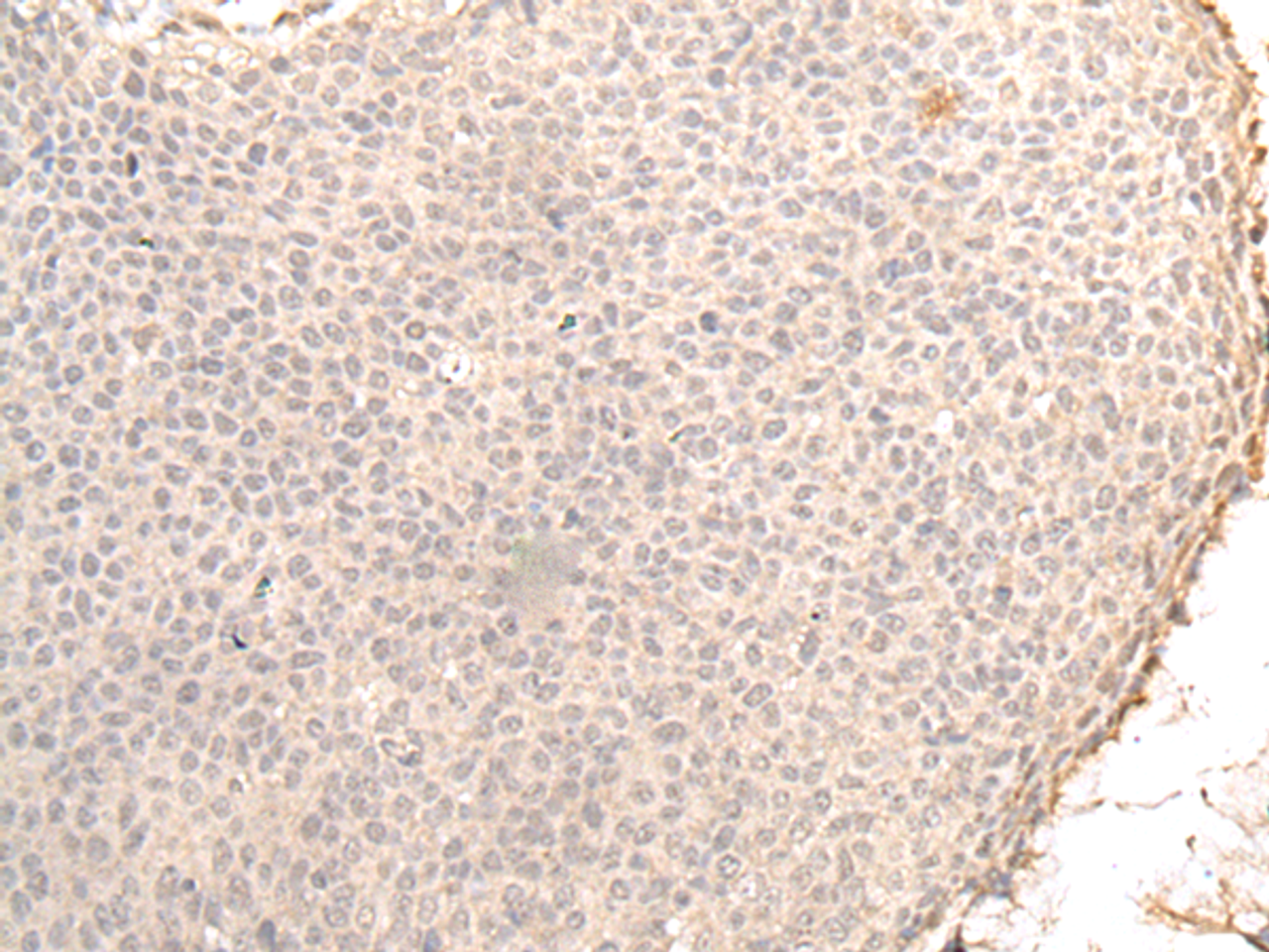 Immunohistochemistry of paraffin-embedded Human cervical cancer tissue  using ZNF263 Polyclonal Antibody at dilution of 1:30(×200)