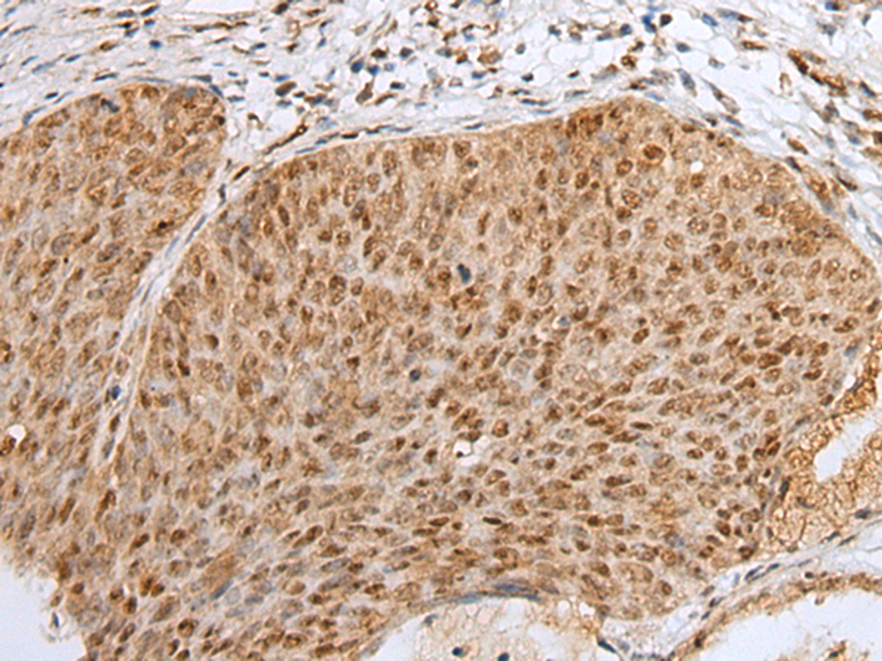 Immunohistochemistry of paraffin-embedded Human cervical cancer tissue  using ZNF354A Polyclonal Antibody at dilution of 1:40(×200)