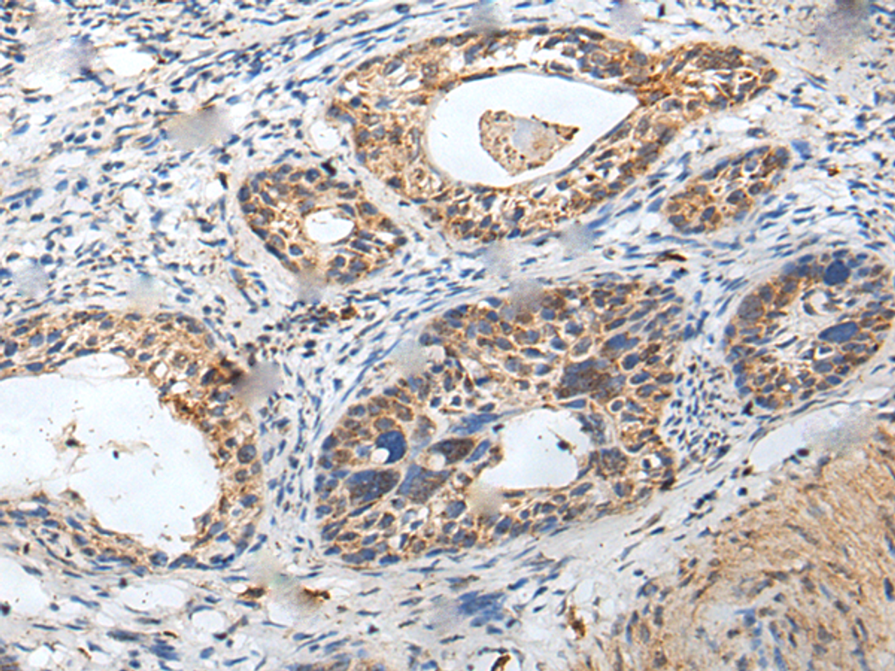Immunohistochemistry of paraffin-embedded Human cervical cancer tissue  using ZPBP Polyclonal Antibody at dilution of 1:30(×200)