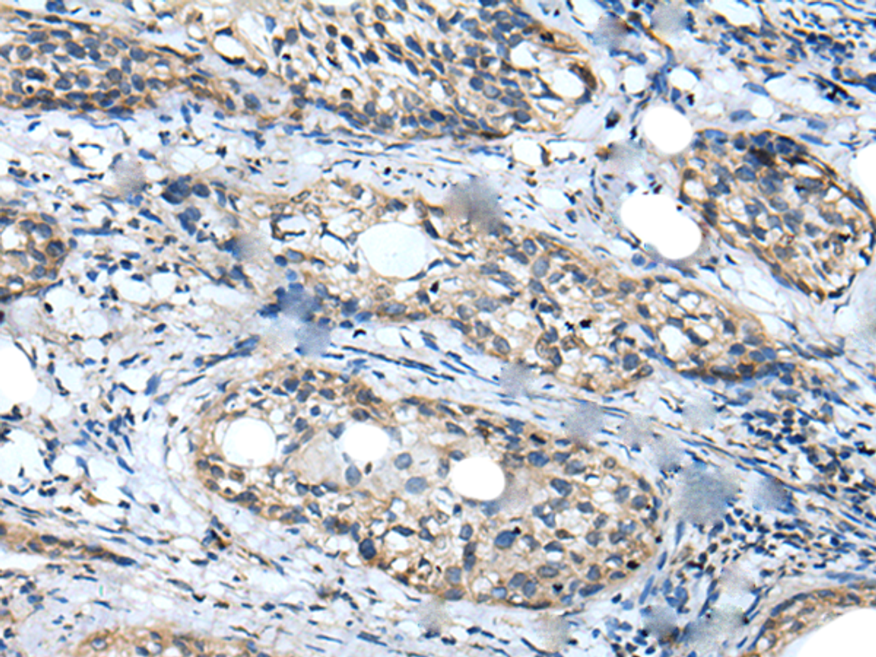 Immunohistochemistry of paraffin-embedded Human cervical cancer tissue  using WDFY2 Polyclonal Antibody at dilution of 1:40(×200)