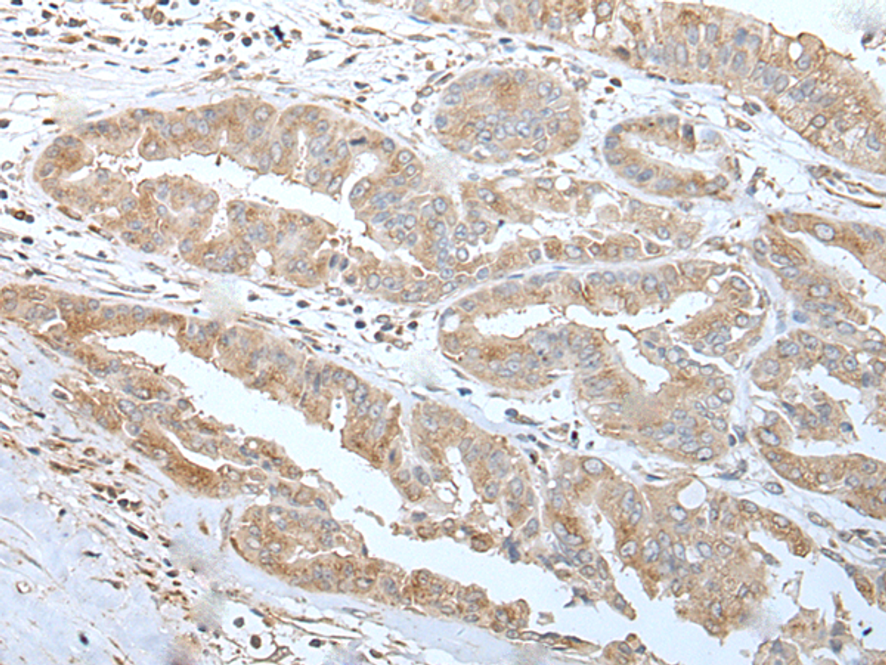Immunohistochemistry of paraffin-embedded Human liver cancer tissue  using USO1 Polyclonal Antibody at dilution of 1:30(×200)