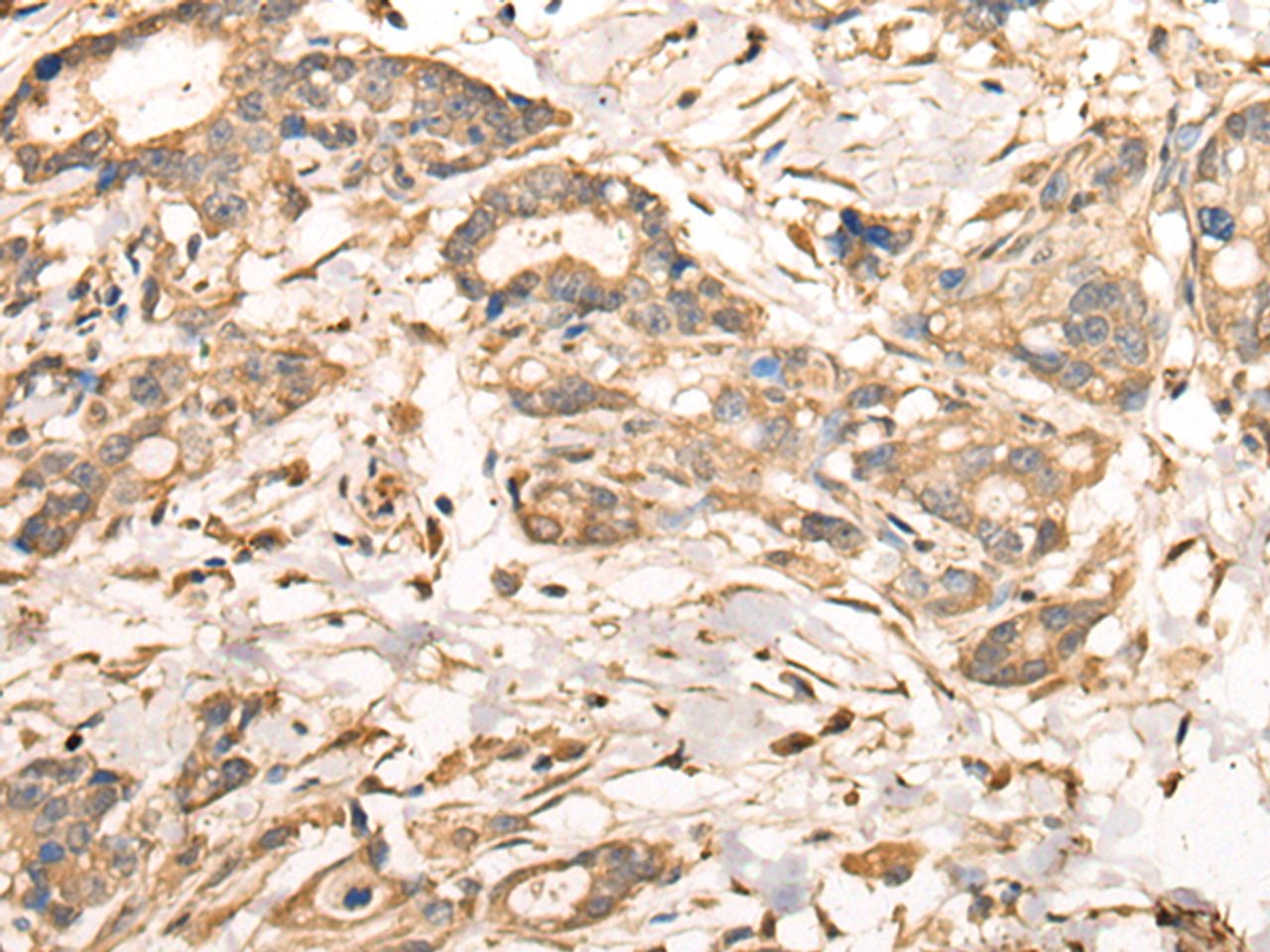 Immunohistochemistry of paraffin-embedded Human gastric cancer tissue  using VTI1A Polyclonal Antibody at dilution of 1:35(×200)