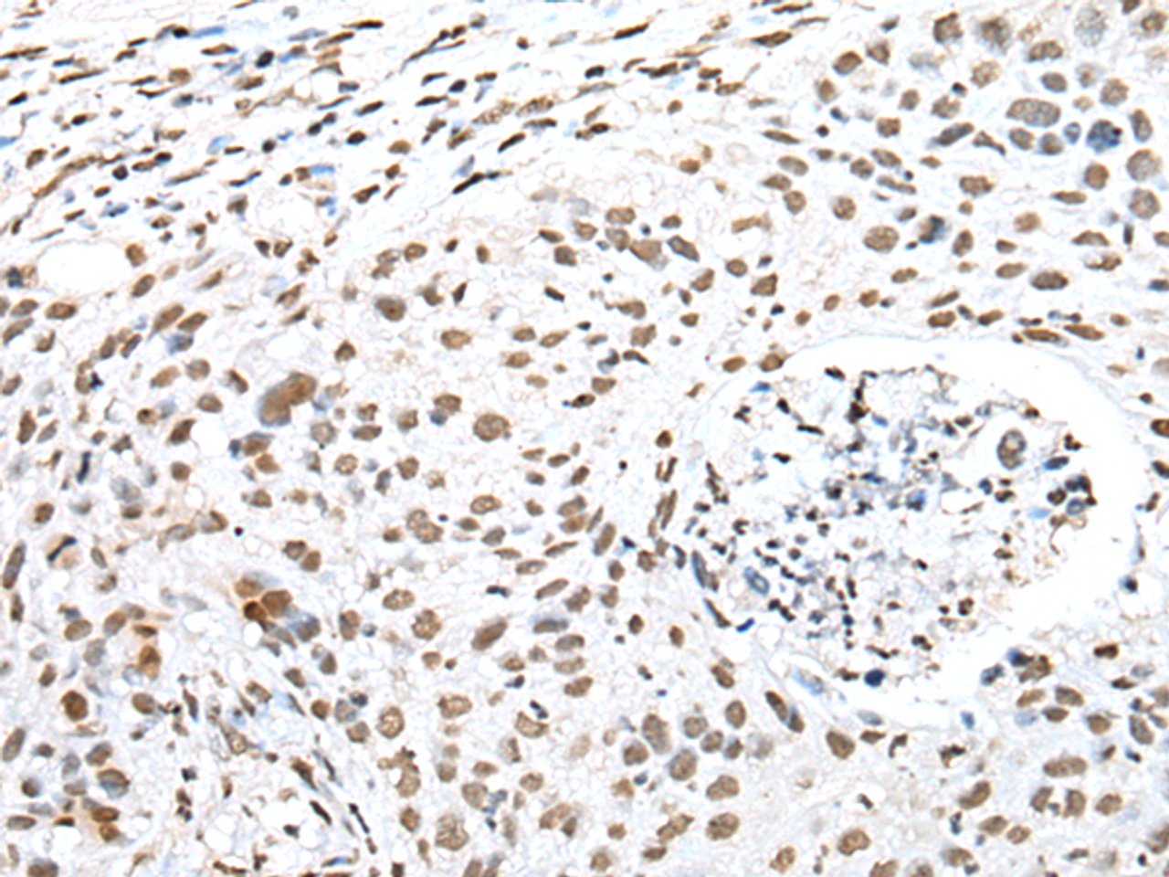 Immunohistochemistry of paraffin-embedded Human lung cancer tissue  using SNRPA Polyclonal Antibody at dilution of 1:30(×200)