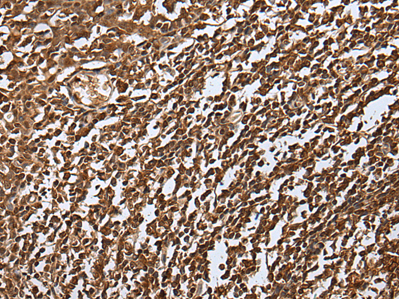 Immunohistochemistry of paraffin-embedded Human tonsil tissue  using UBE2V1 Polyclonal Antibody at dilution of 1:30(×200)