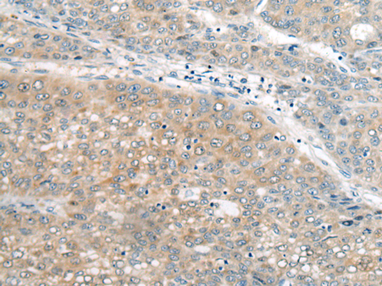 Immunohistochemistry of paraffin-embedded Human liver cancer tissue  using UBE2G2 Polyclonal Antibody at dilution of 1:55(×200)