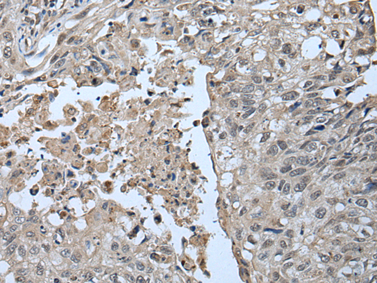 Immunohistochemistry of paraffin-embedded Human lung cancer tissue  using UBR2 Polyclonal Antibody at dilution of 1:55(×200)