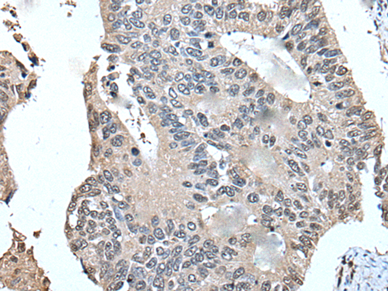 Immunohistochemistry of paraffin-embedded Human colorectal cancer tissue  using UFM1 Polyclonal Antibody at dilution of 1:45(×200)