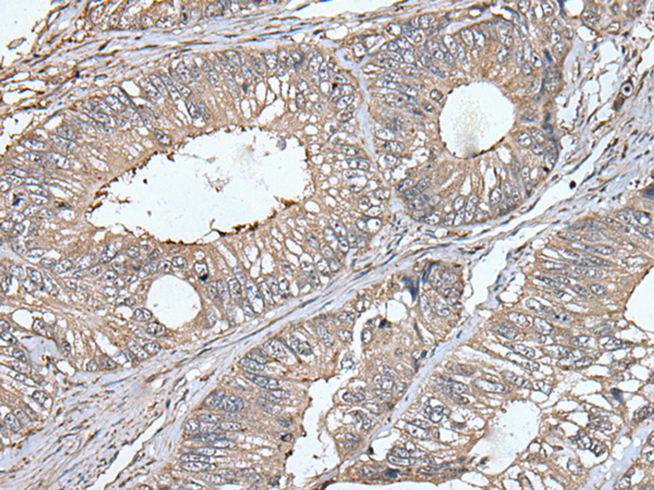 Immunohistochemistry of paraffin-embedded Human colorectal cancer tissue  using UNC13B Polyclonal Antibody at dilution of 1:40(×200)