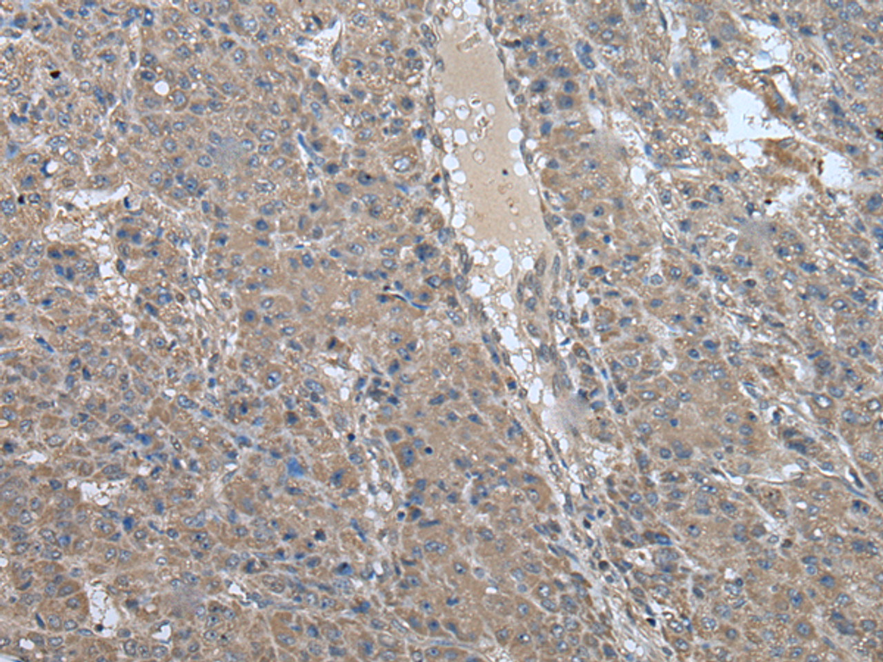 Immunohistochemistry of paraffin-embedded Human liver cancer tissue  using USP32 Polyclonal Antibody at dilution of 1:75(×200)