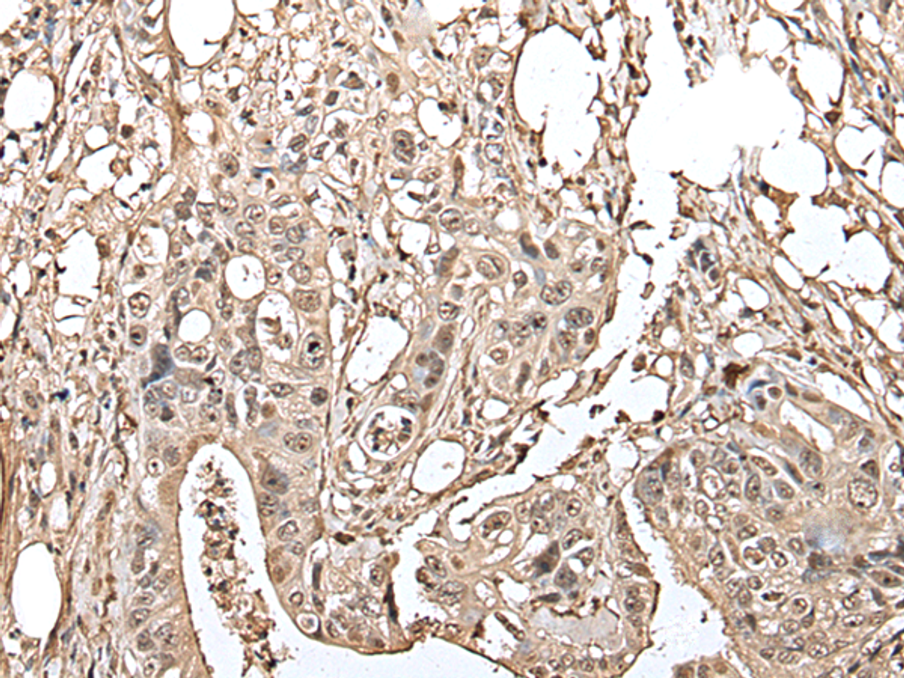 Immunohistochemistry of paraffin-embedded Human colorectal cancer tissue  using UTP3 Polyclonal Antibody at dilution of 1:40(×200)