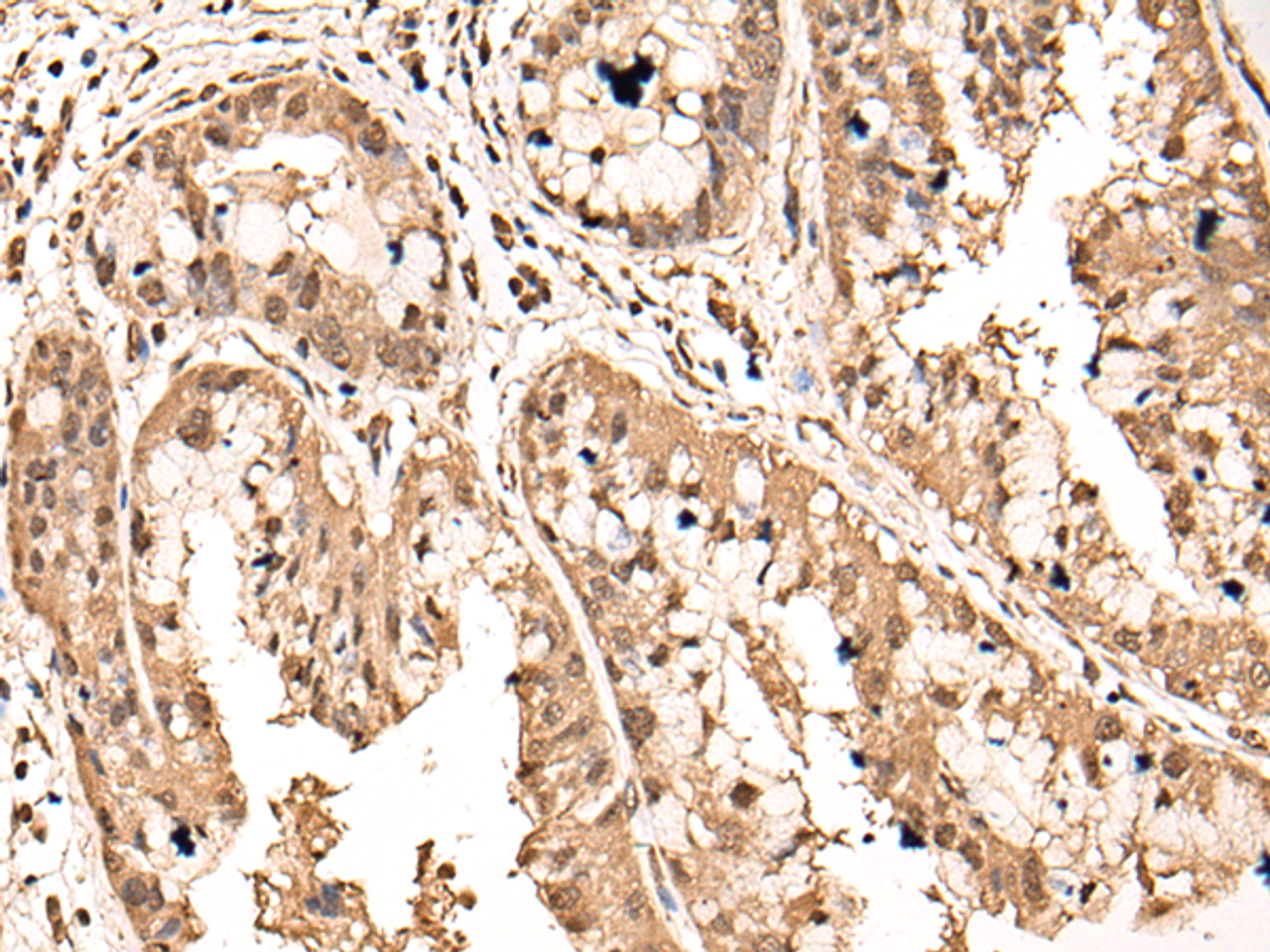 Immunohistochemistry of paraffin-embedded Human liver cancer tissue  using ATAD3A Polyclonal Antibody at dilution of 1:40(×200)