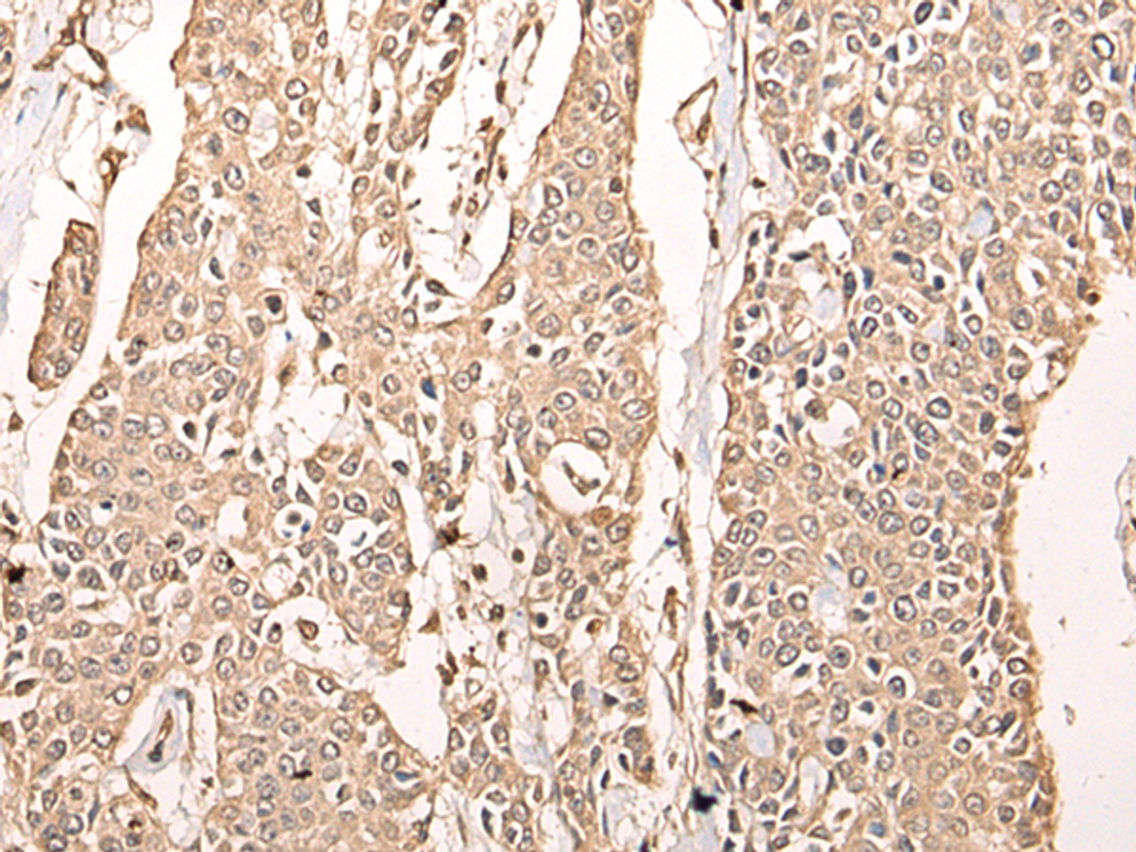 Immunohistochemistry of paraffin-embedded Human prost ate cancer tissue  using ATAD3A Polyclonal Antibody at dilution of 1:40(×200)