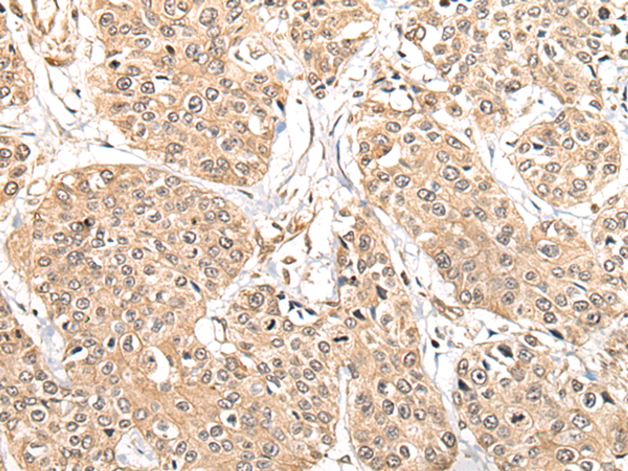 Immunohistochemistry of paraffin-embedded Human prost at e cancer tissue  using ATL3 Polyclonal Antibody at dilution of 1:85(×200)