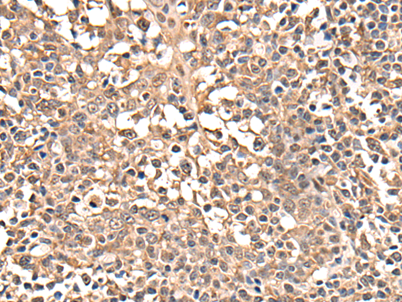 Immunohistochemistry of paraffin-embedded Human tonsil tissue  using ATRIP Polyclonal Antibody at dilution of 1:40(×200)