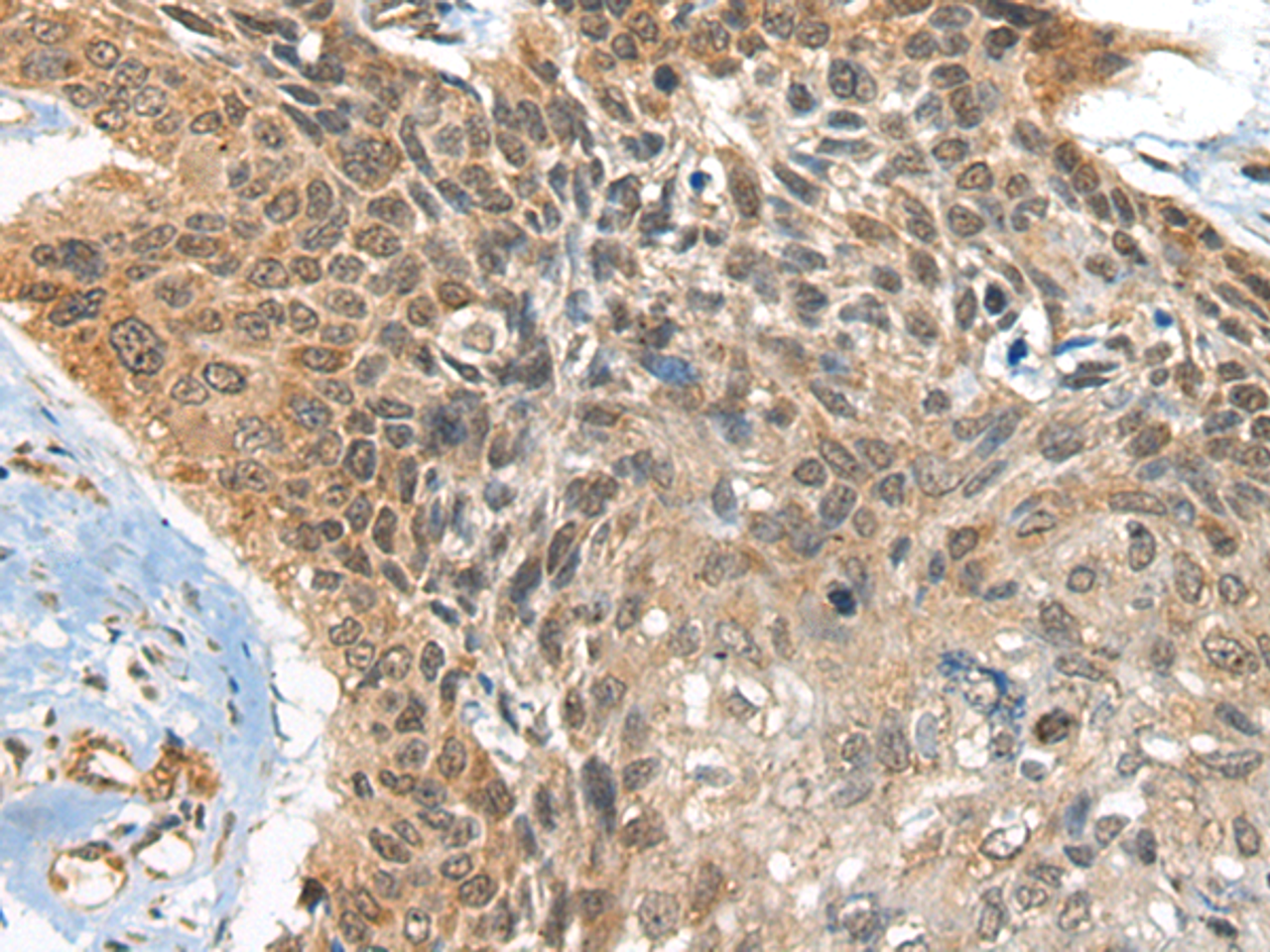 Immunohistochemistry of paraffin-embedded Human esophagus cancer tissue  using BOLA1 Polyclonal Antibody at dilution of 1:35(×200)