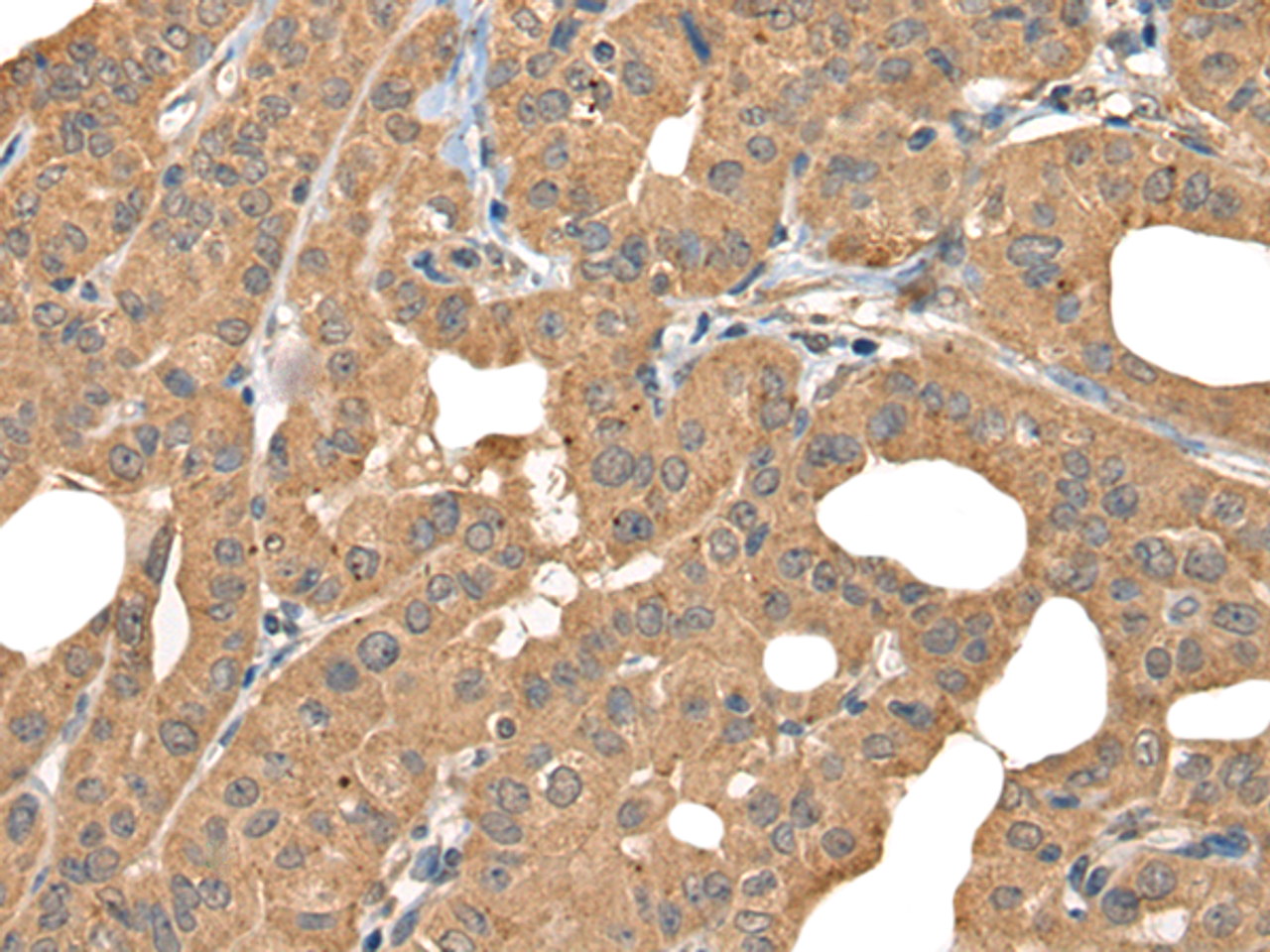 Immunohistochemistry of paraffin-embedded Human thyroid cancer tissue  using BOLA1 Polyclonal Antibody at dilution of 1:35(×200)