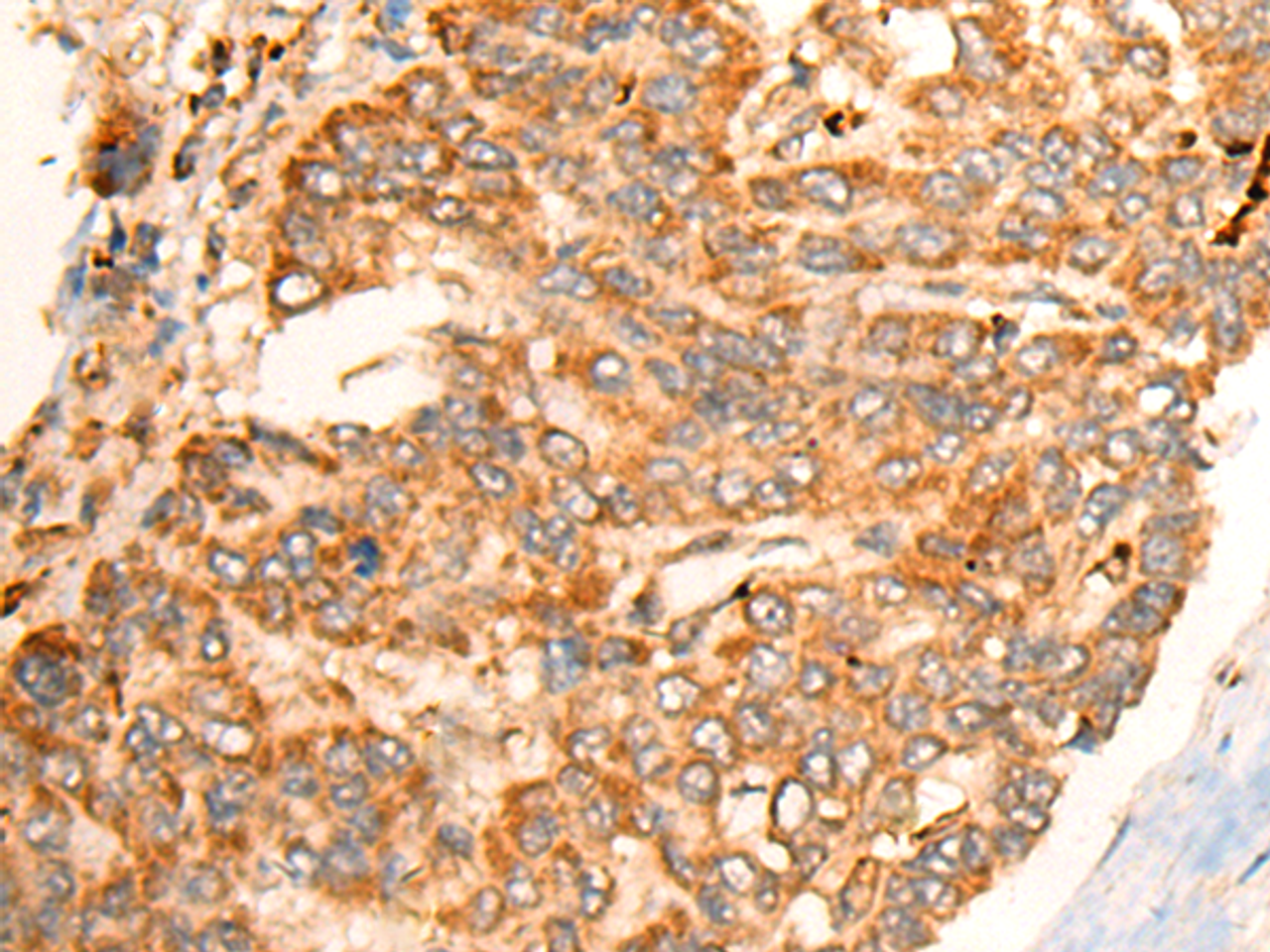 Immunohistochemistry of paraffin-embedded Human liver cancer tissue  using BPGM Polyclonal Antibody at dilution of 1:70(×200)