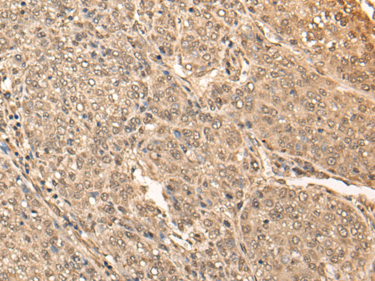 Immunohistochemistry of paraffin-embedded Human liver cancer tissue  using BRF2 Polyclonal Antibody at dilution of 1:40(×200)