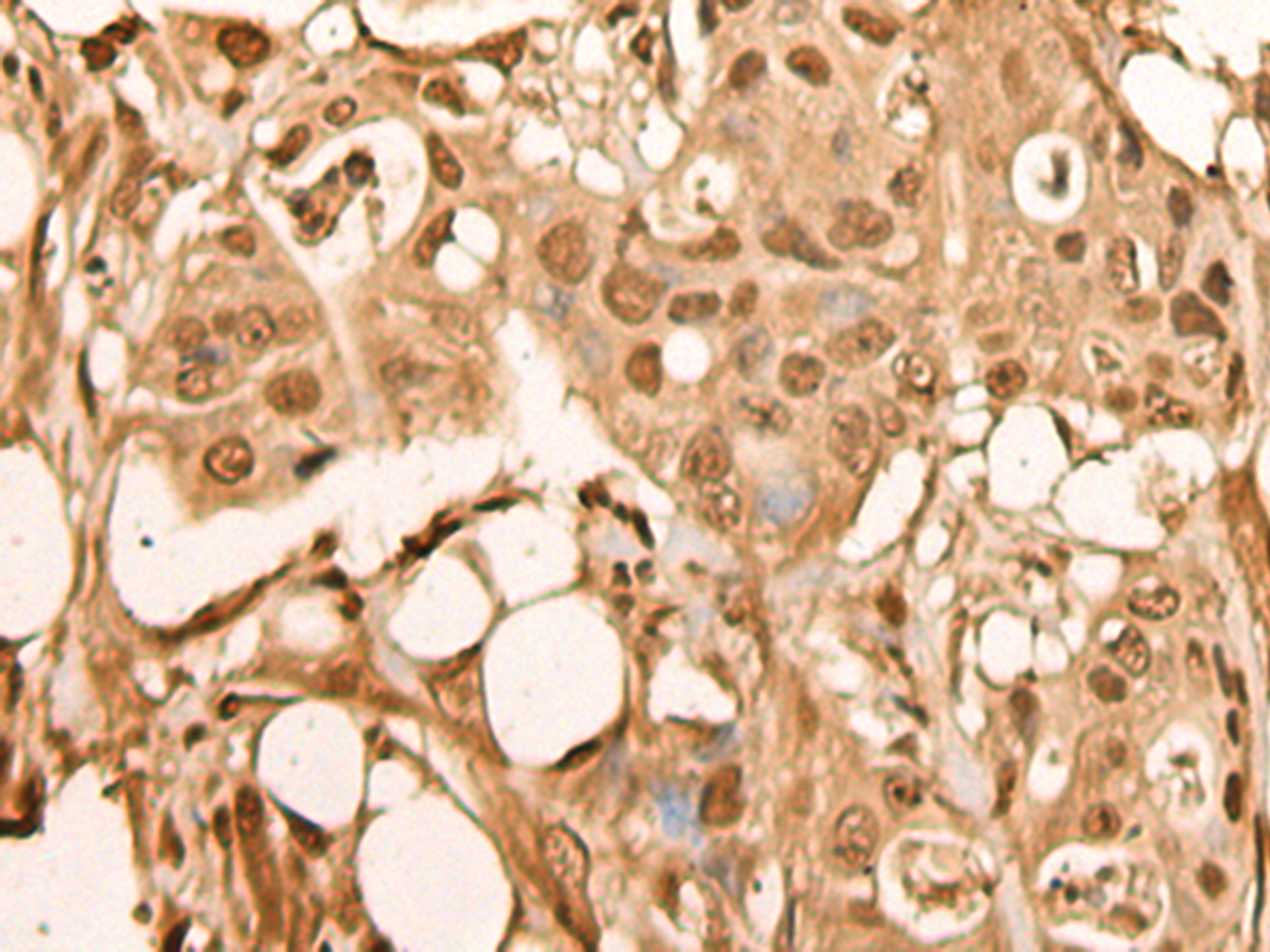 Immunohistochemistry of paraffin-embedded Human colorectal cancer tissue  using BRF2 Polyclonal Antibody at dilution of 1:40(×200)