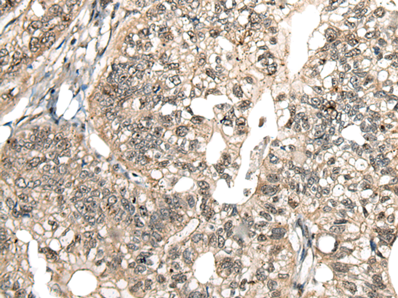 Immunohistochemistry of paraffin-embedded Human gastric cancer tissue  using MCPH1 Polyclonal Antibody at dilution of 1:110(×200)