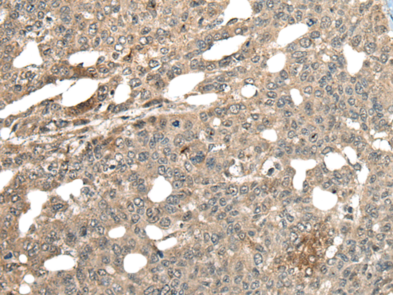 Immunohistochemistry of paraffin-embedded Human liver cancer tissue  using MCPH1 Polyclonal Antibody at dilution of 1:110(×200)