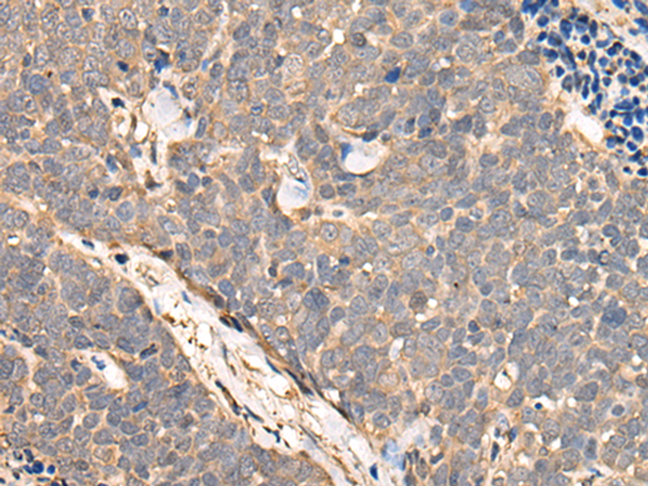 Immunohistochemistry of paraffin-embedded Human thyroid cancer tissue  using NCAPH Polyclonal Antibody at dilution of 1:45(×200)