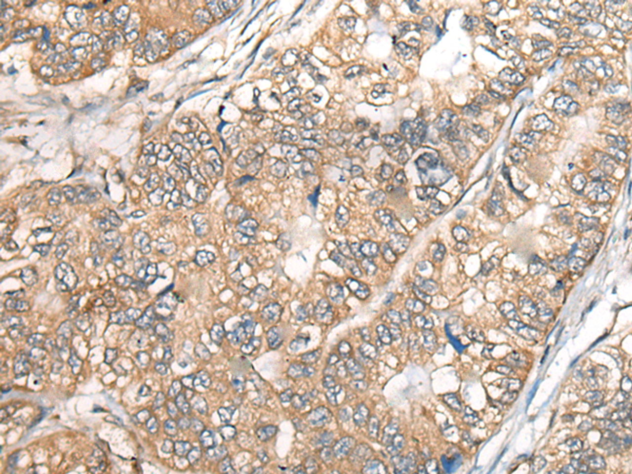 Immunohistochemistry of paraffin-embedded Human gastric cancer tissue  using BCHE Polyclonal Antibody at dilution of 1:40(×200)