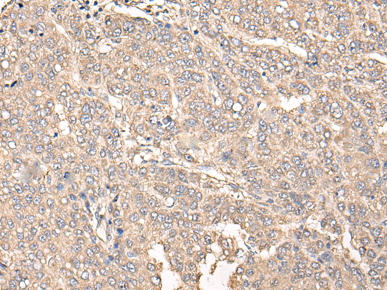 Immunohistochemistry of paraffin-embedded Human liver cancer tissue  using C12orf40 Polyclonal Antibody at dilution of 1:50(×200)