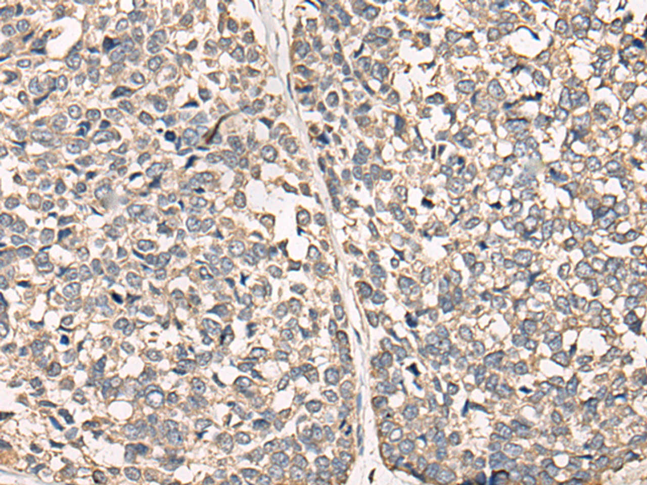 Immunohistochemistry of paraffin-embedded Human esophagus cancer tissue  using C12orf40 Polyclonal Antibody at dilution of 1:50(×200)