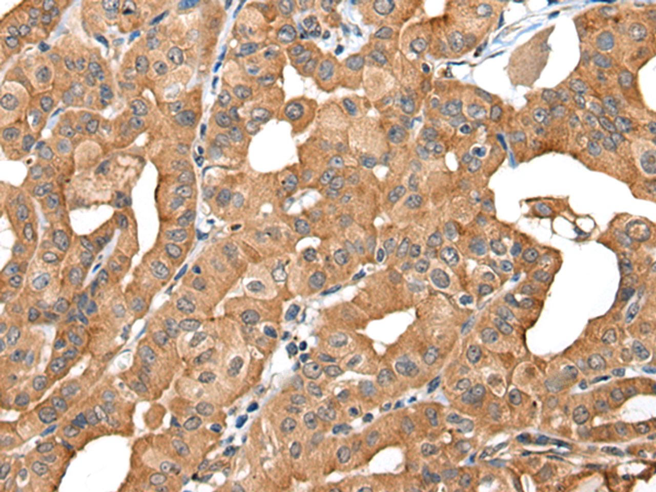 Immunohistochemistry of paraffin-embedded Human thyroid cancer tissue  using INF2 Polyclonal Antibody at dilution of 1:40(×200)