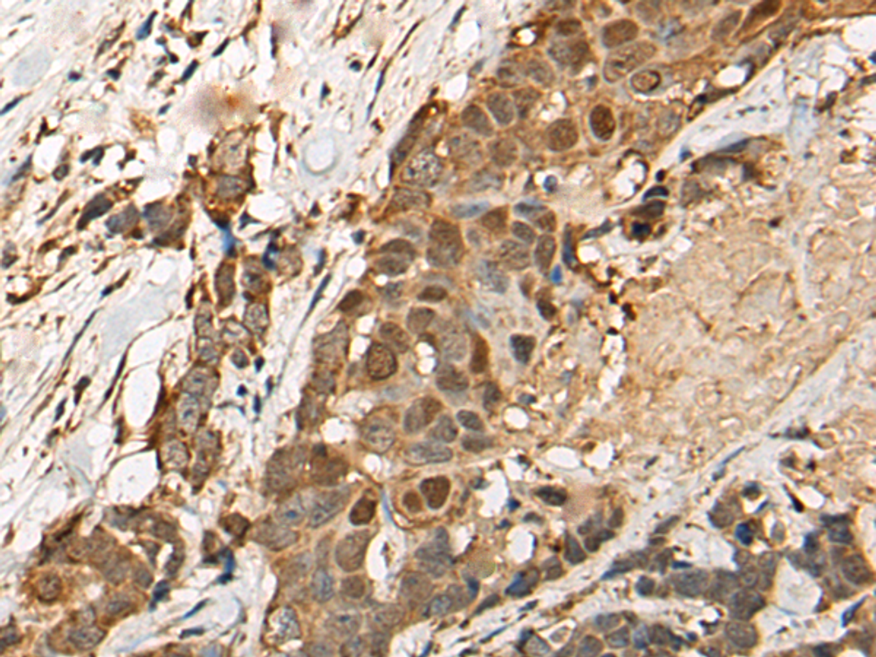 Immunohistochemistry of paraffin-embedded Human thyroid cancer tissue  using HEATR9 Polyclonal Antibody at dilution of 1:110(×200)
