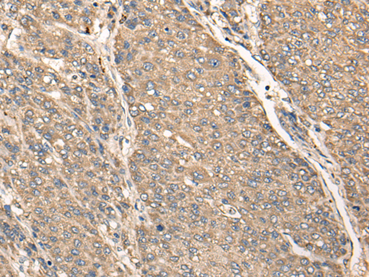 Immunohistochemistry of paraffin-embedded Human liver cancer tissue  using C17orf67 Polyclonal Antibody at dilution of 1:50(×200)