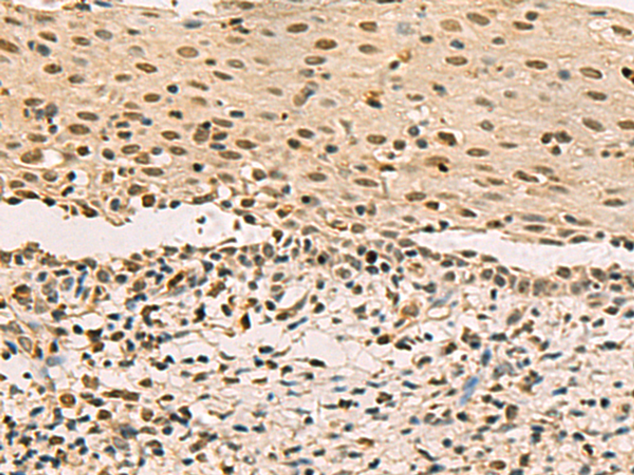 Immunohistochemistry of paraffin-embedded Human cervical cancer tissue  using LRIF1 Polyclonal Antibody at dilution of 1:70(×200)
