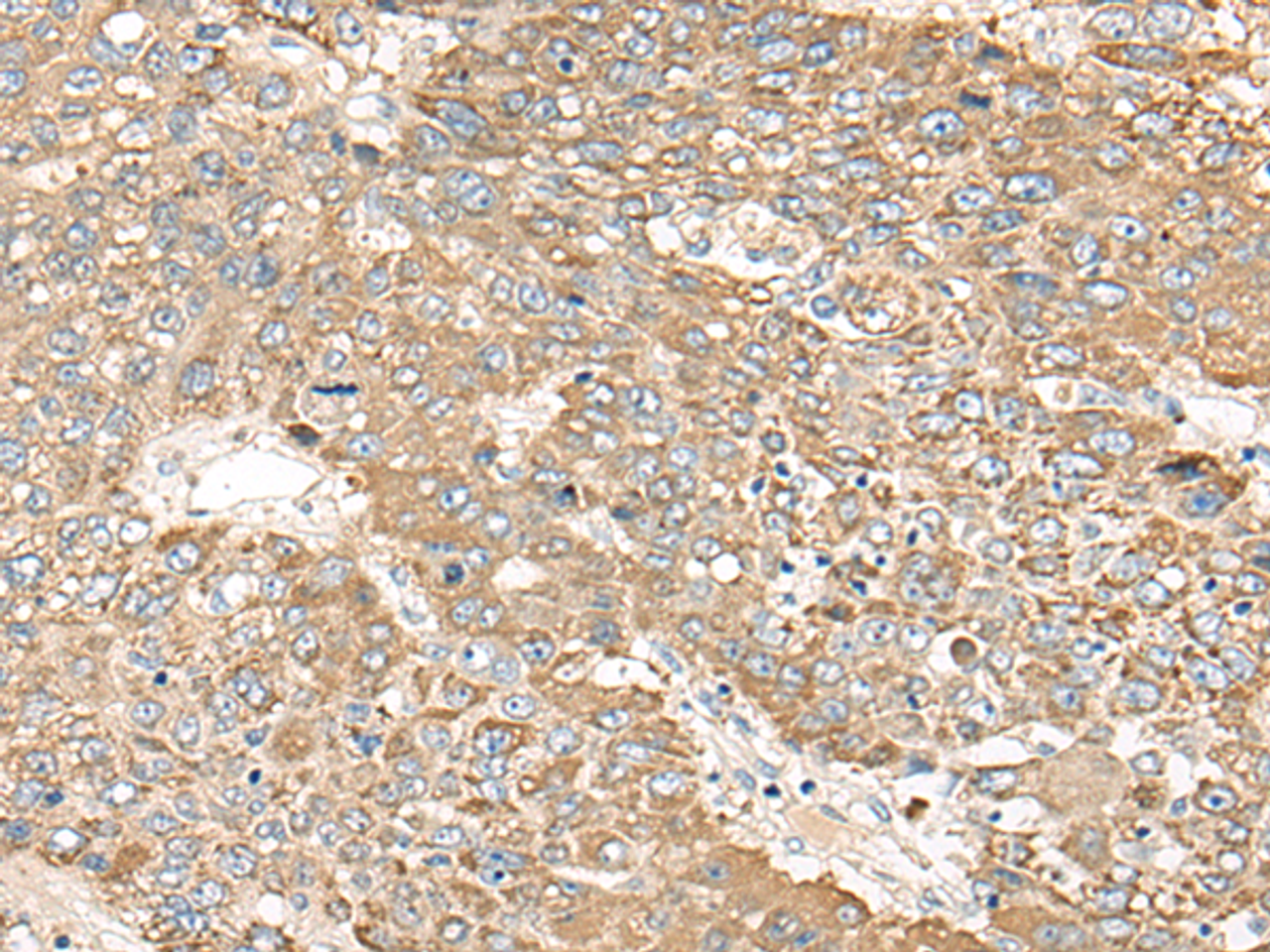 Immunohistochemistry of paraffin-embedded Human liver cancer tissue  using C1orf101 Polyclonal Antibody at dilution of 1:65(×200)