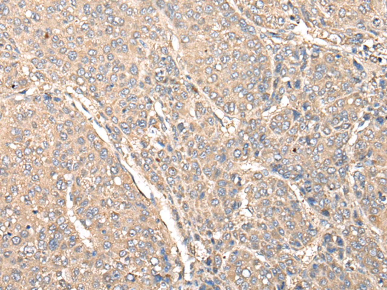 Immunohistochemistry of paraffin-embedded Human liver cancer tissue  using C1orf106 Polyclonal Antibody at dilution of 1:80(×200)