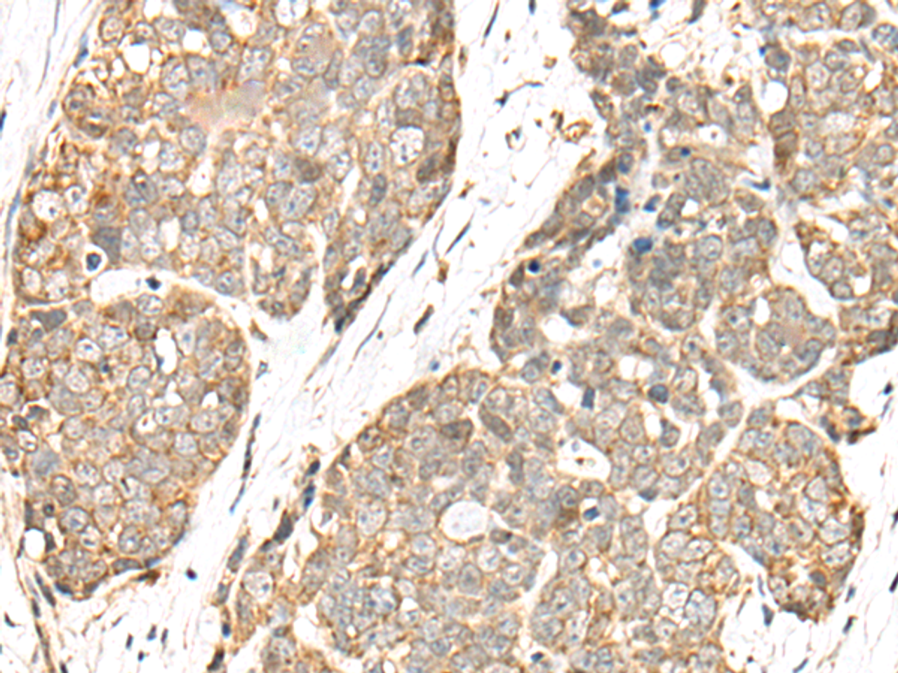 Immunohistochemistry of paraffin-embedded Human thyroid cancer tissue  using COA7 Polyclonal Antibody at dilution of 1:55(×200)