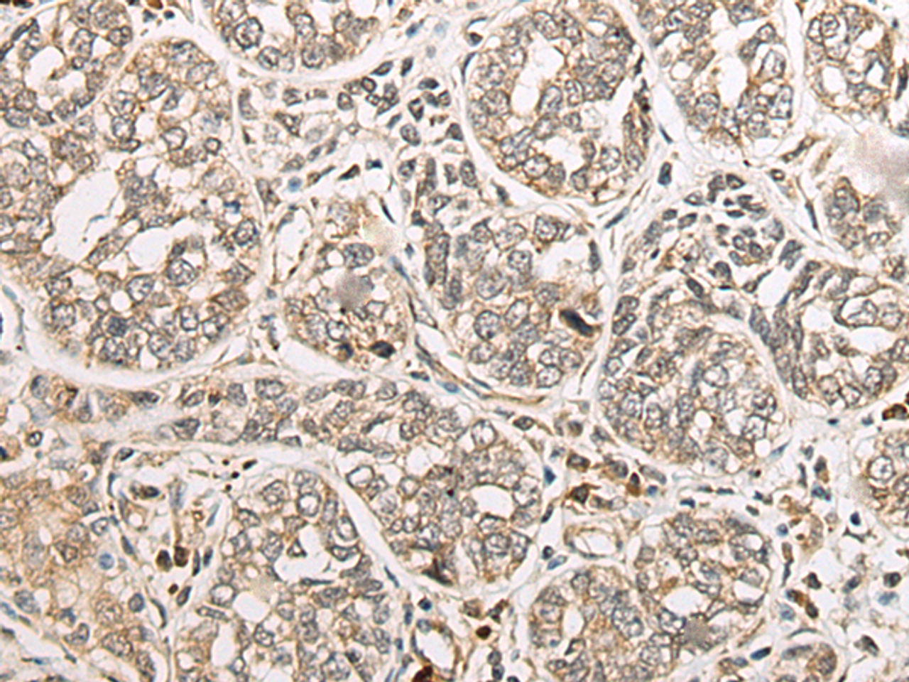 Immunohistochemistry of paraffin-embedded Human esophagus cancer tissue  using COA7 Polyclonal Antibody at dilution of 1:55(×200)