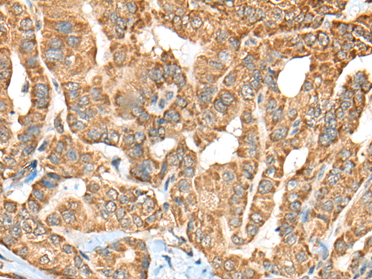 Immunohistochemistry of paraffin-embedded Human thyroid cancer tissue  using C1R Polyclonal Antibody at dilution of 1:70(×200)