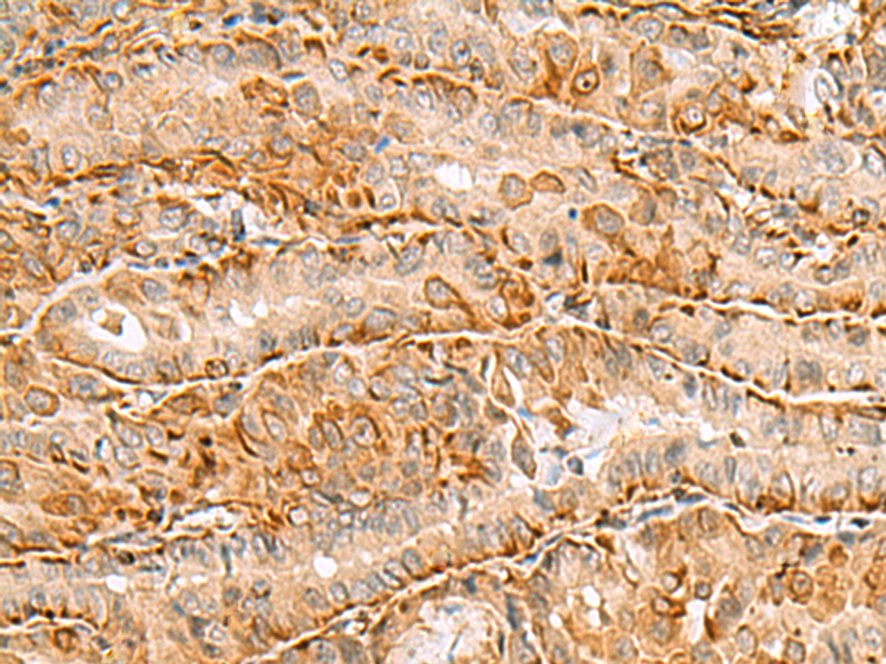Immunohistochemistry of paraffin-embedded Human thyroid cancer tissue  using C3orf38 Polyclonal Antibody at dilution of 1:80(×200)
